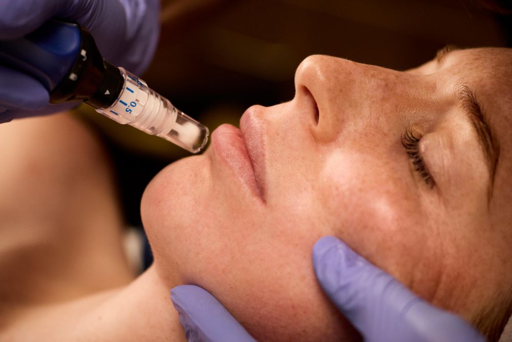 SkinPen microneedling, close detail